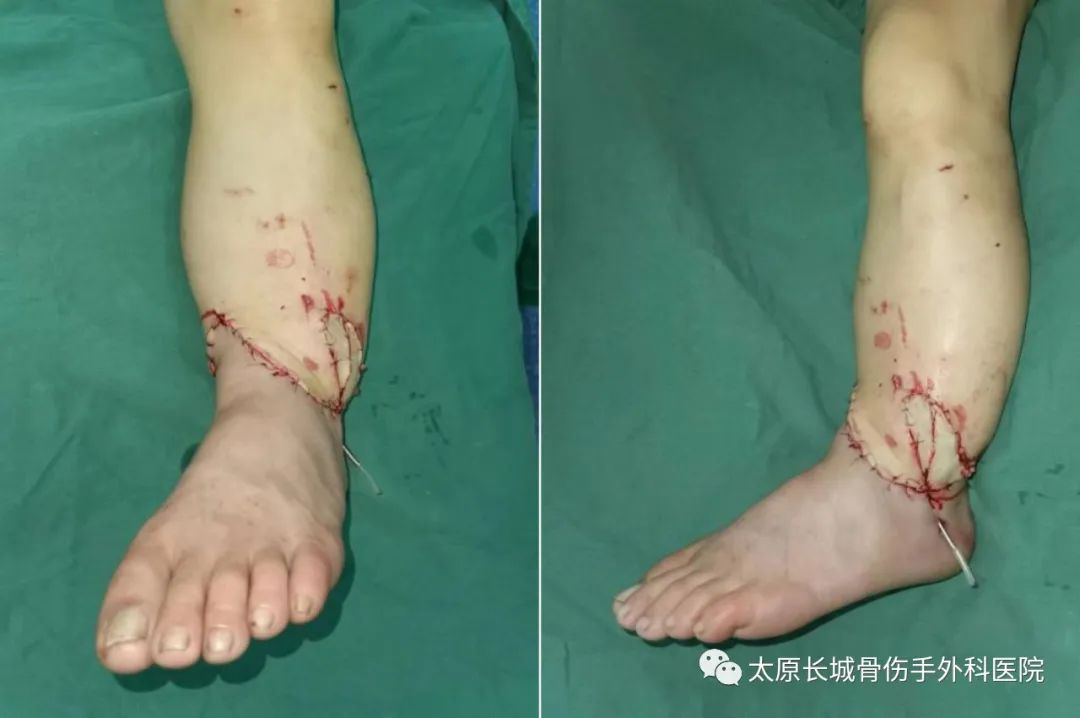 是太原市民营医院中较早成立的专科之一,在肢体离断治疗方面积累了