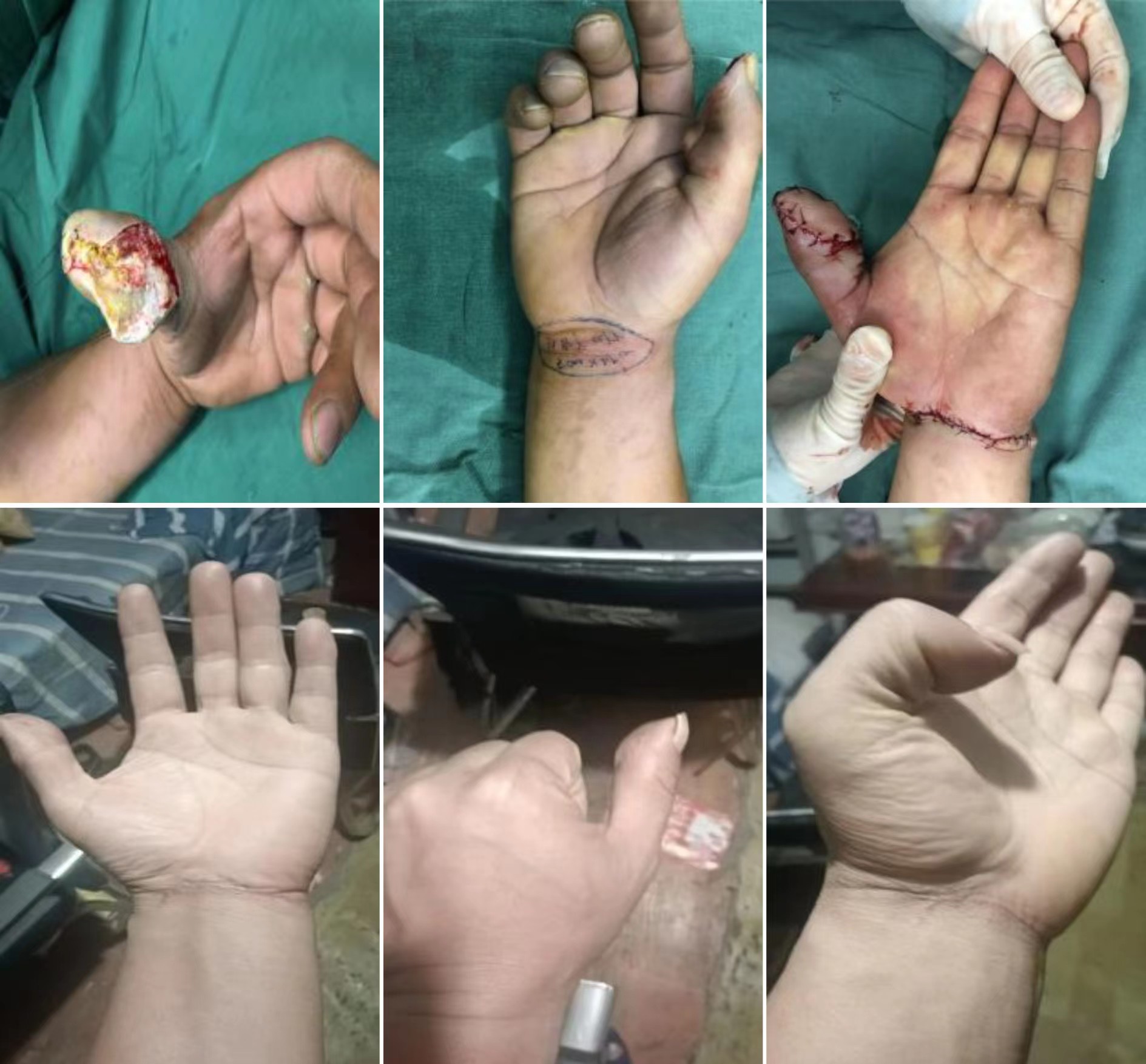 李某,男,30岁,右拇指角磨机伤3小时.